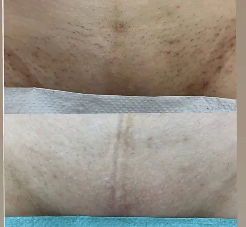 Bikini area: Before / After