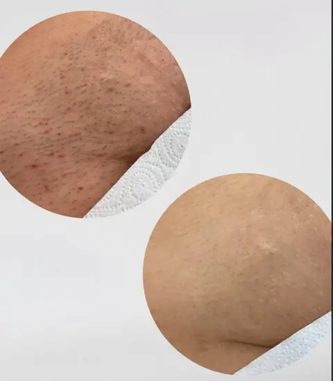 Bikini line: Before / After