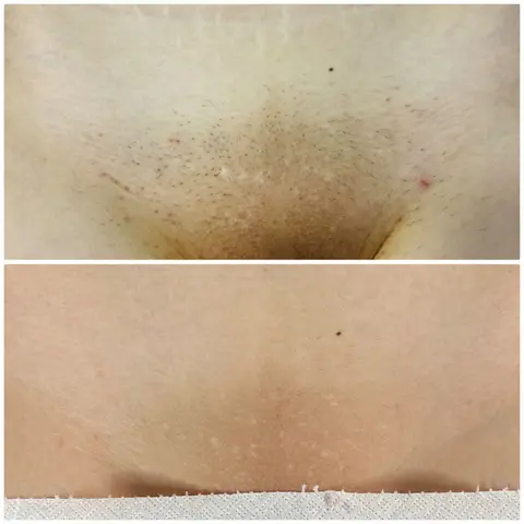 Deep bikini: Before / After