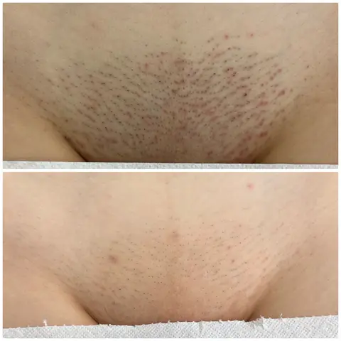 Deep bikini: Before / After