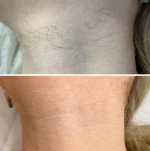 Neck: Before / After