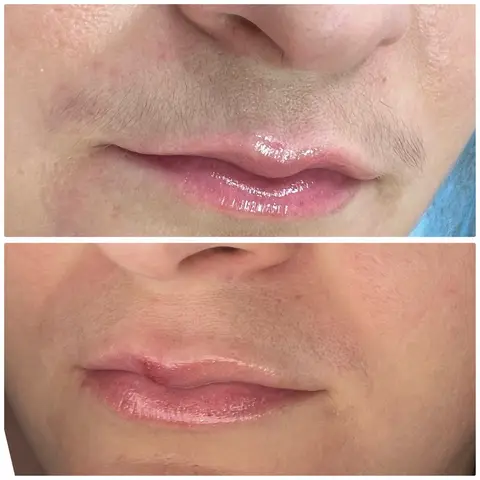 Upper lip: Before / After